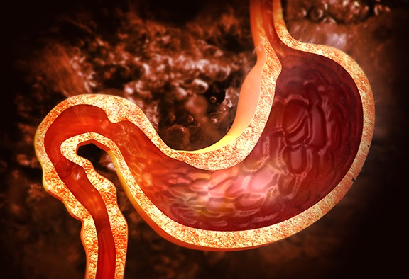gastroparesis and diabetes