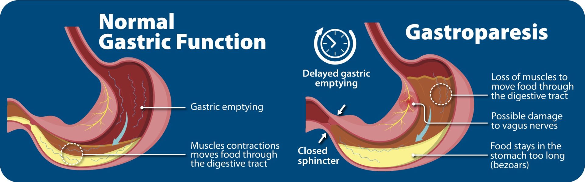 gastroparesis-impact-on-digestion-diagram